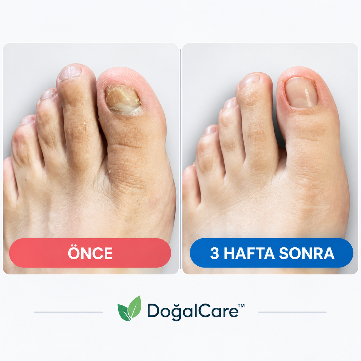 Doğalcare™ Mantar Tırnak Yamaları