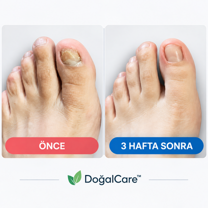 Doğalcare™ Mantar Tırnak Yamaları